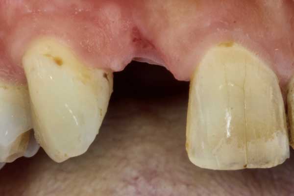 Dental bridge Case 1