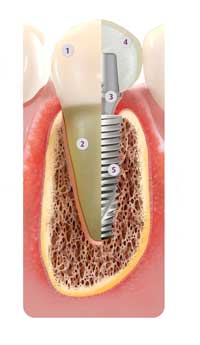 Implant-and-tooth-in-cross-section-Numbered