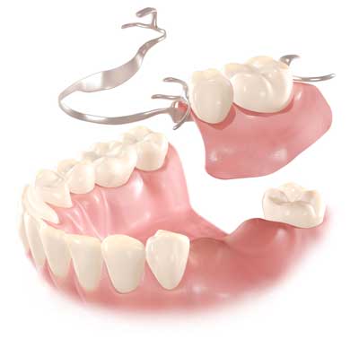 Partial-denture
