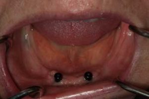 Case 2 dental implants pre op photo