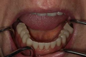 Case 2 dental implants complete photo