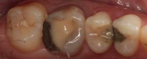 Dental Crown preop