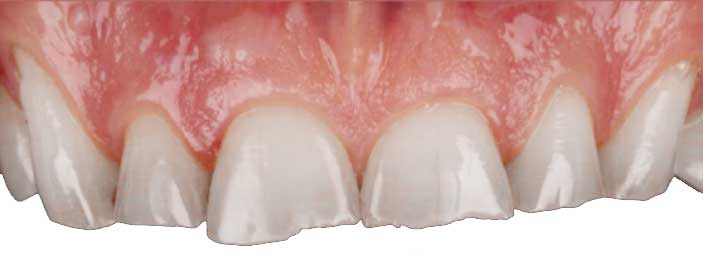 Teeth-Damaged-1---FastSmile-a